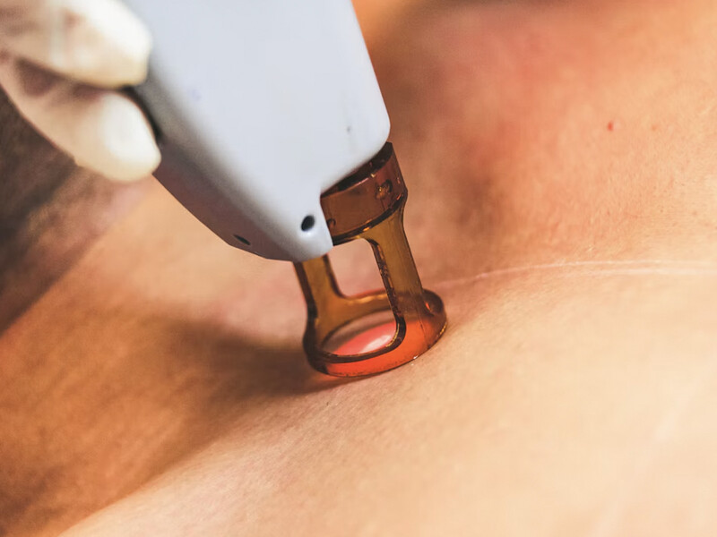 Laserontharing vergoed? Zo zit het met de zorgverzekering